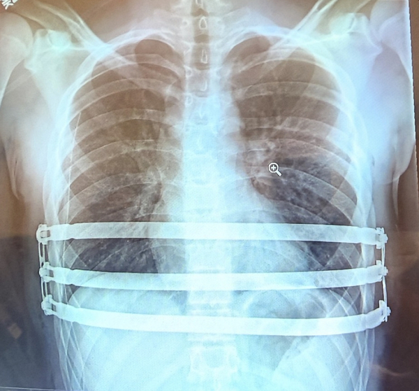 ▲자로주스키 박사가 팩투스(Pectus) 수술을 집도 한 후 촬영한 흉부 X-ray 영상 이미지